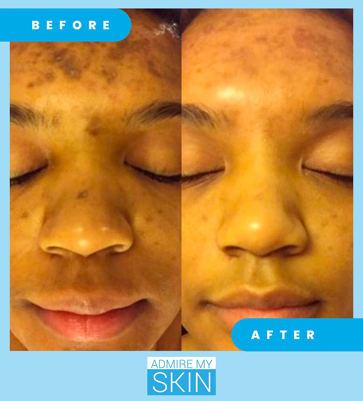 Admire My Skin Dark Spot Corrector Serum + Retinoid Cream Set
