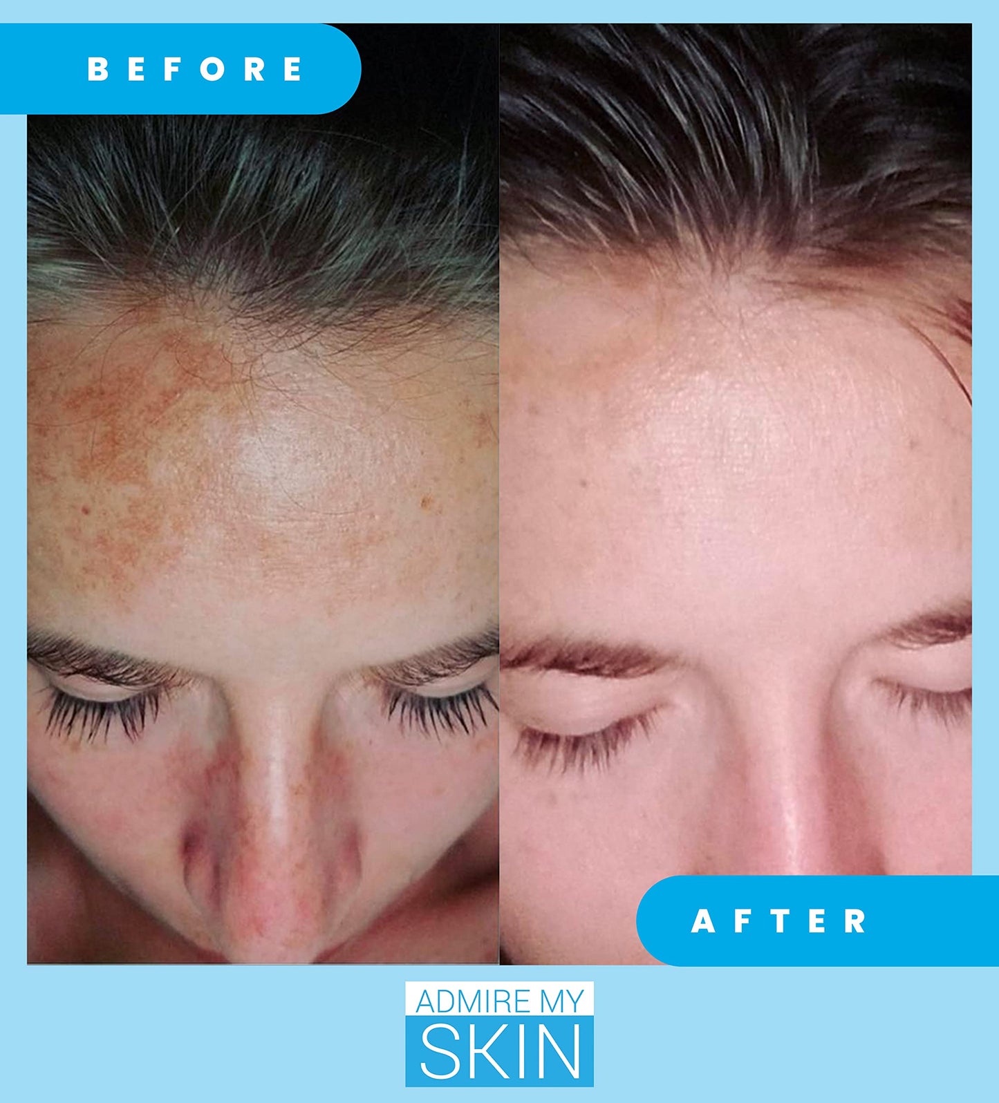 Admire My Skin Dark Spot Corrector Serum + Retinoid Cream Set